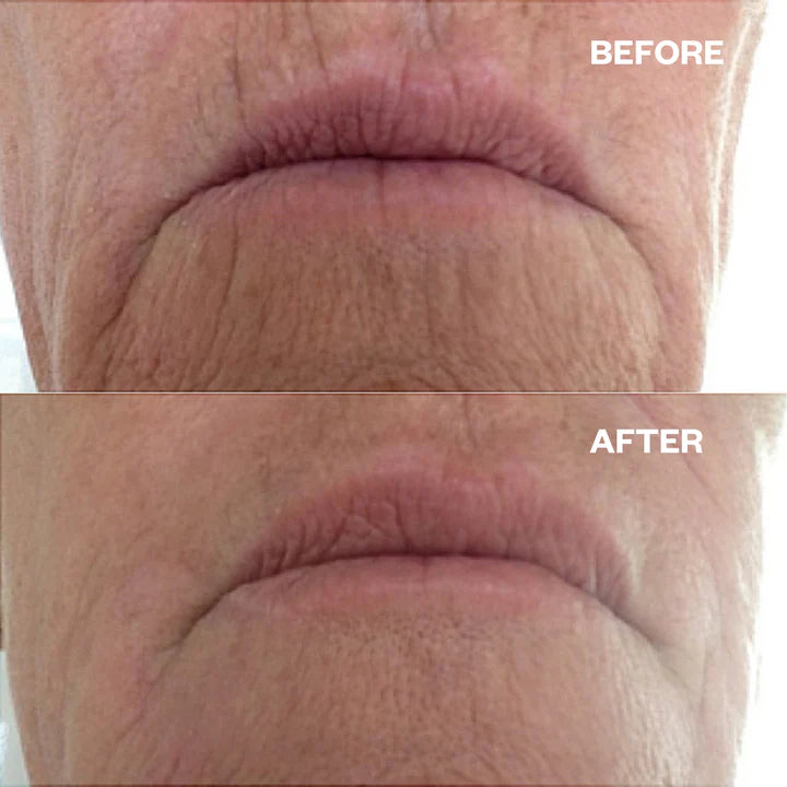 Mouth & Lip Wrinkle Patches